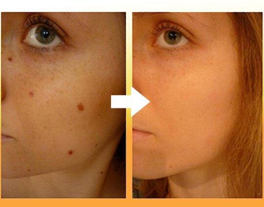 Instant Blemish Removal Gel