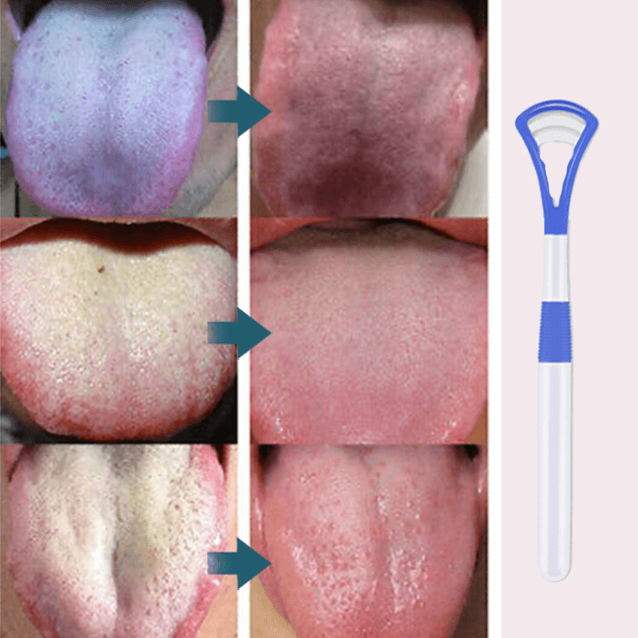 BreathRefresh™ Tongue Scraping Cleaner